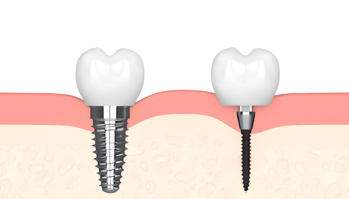 Dental Implants Cost in Emeryville, CA | Mini Implants vs. Conventional Implants