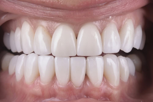 Alargamiento de corona dental en Wayne, NJ | Fine Dental Care