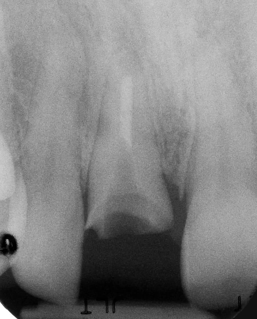 single tooth replacement, upper incisor tooth