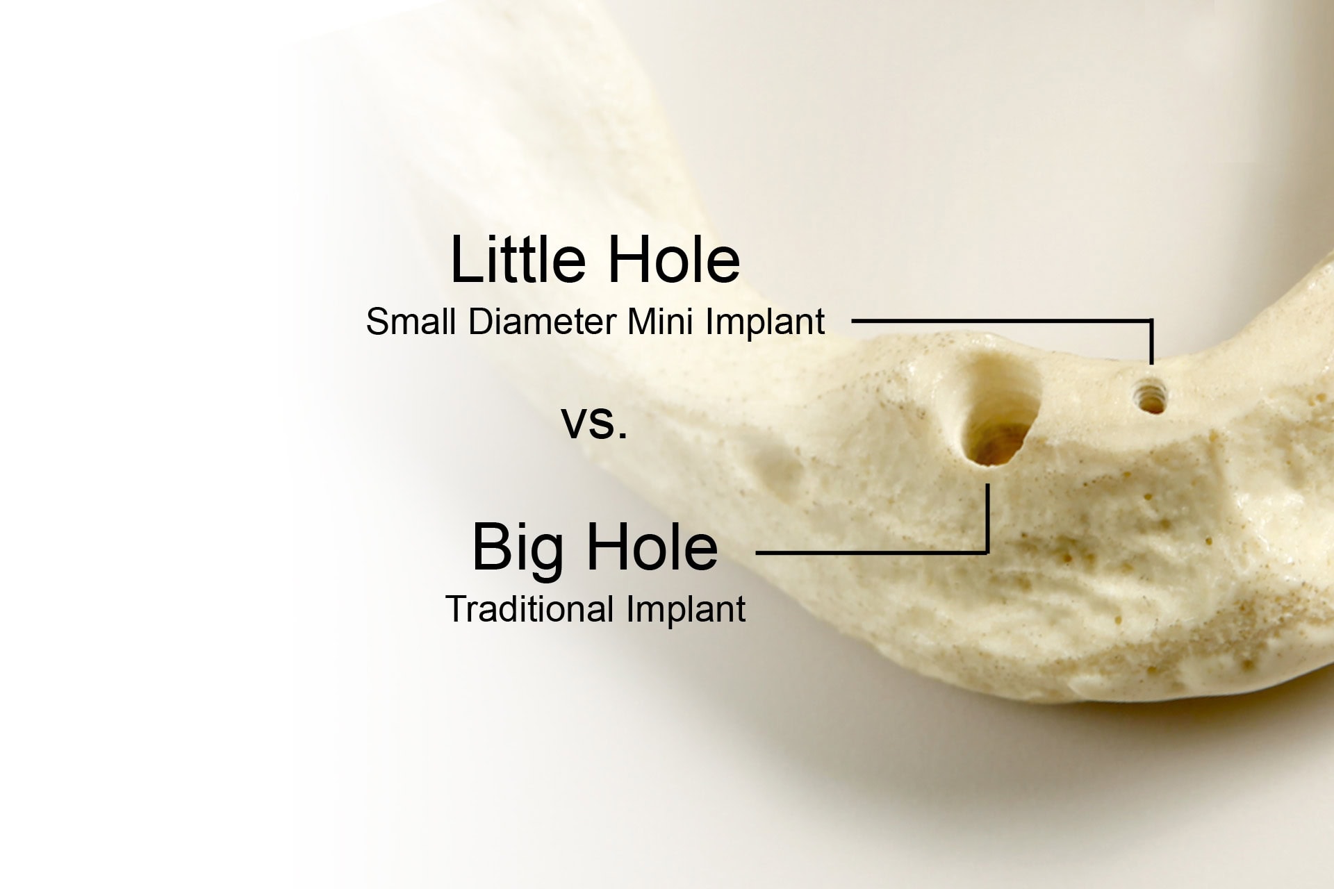 Alternativa ClearChoice en Tampa, FL | Beneficios de los Mini Implantes Dentales