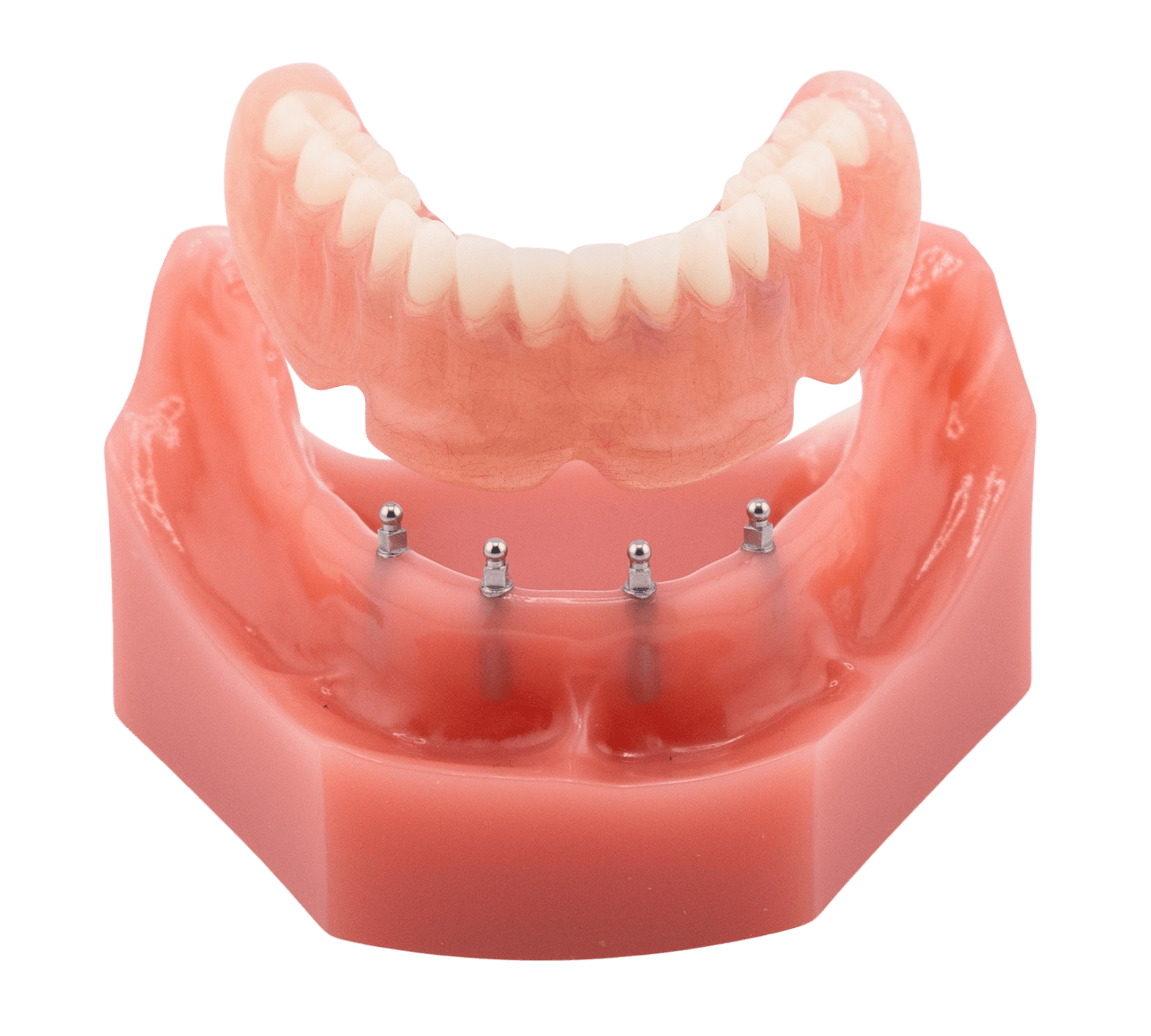 Alternatives to Dentures in Sterling Heights, MI | Secure Your Smile