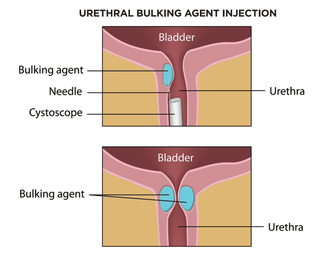 Urethral Bulking for Stress Urinary incontinence - Brazosport Women's ...