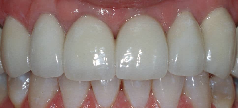 upper anterior bridge