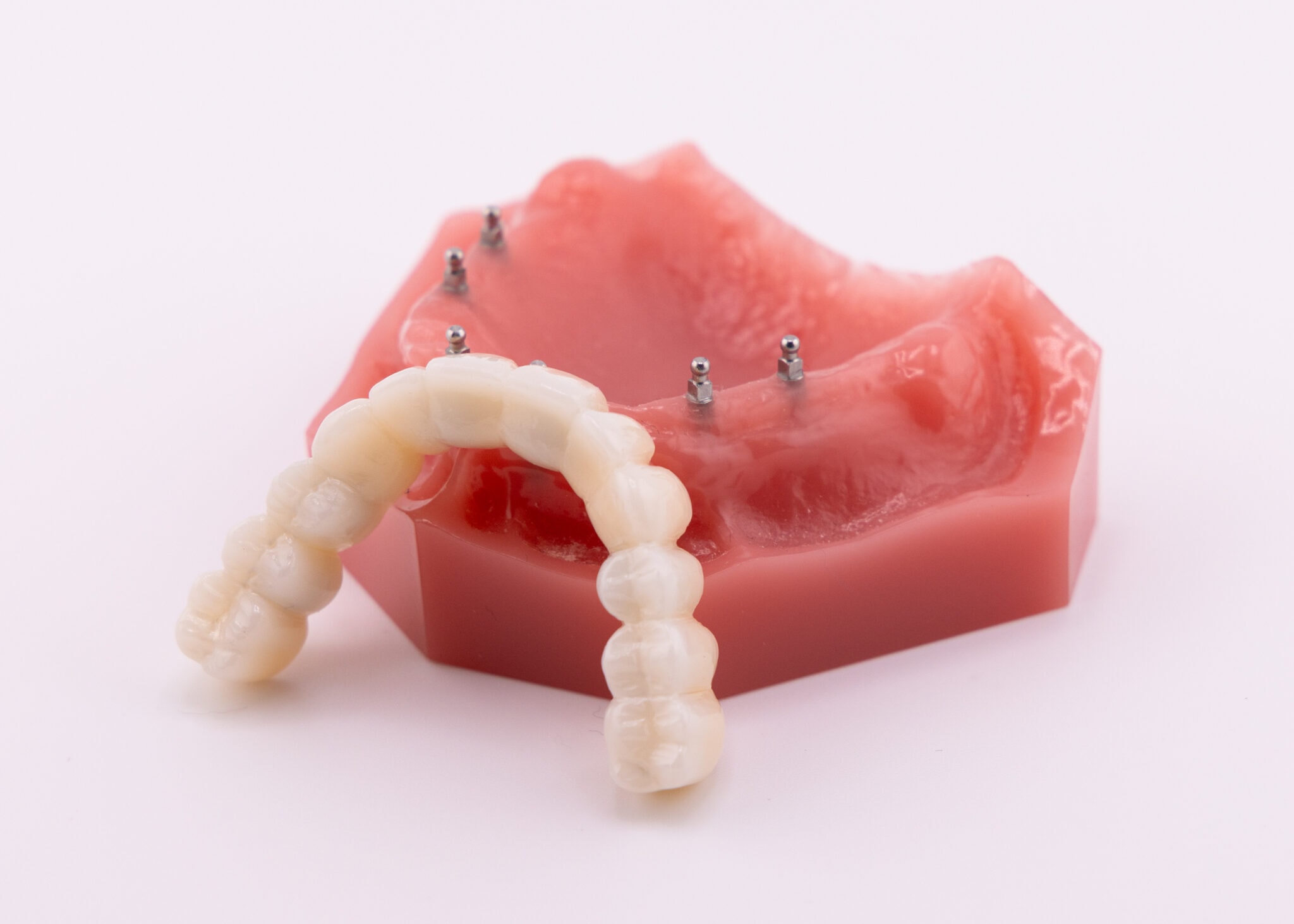 When Are Mini Implants the Recommended Option?