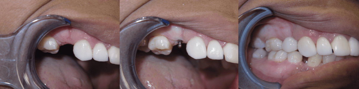 Dental Implants Butler PA | Brockley Dental Center | Call Us Today!