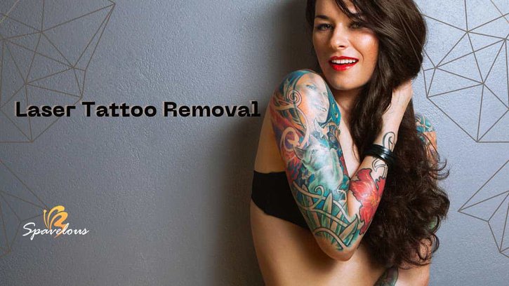 laser tattoo removal
