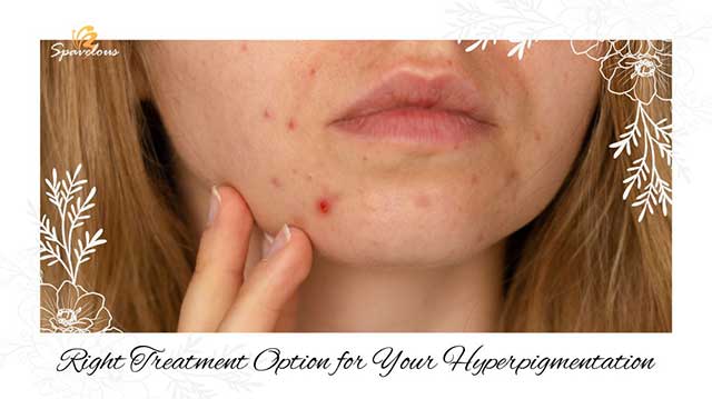 ULTIMATE GUIDE TO HYPERPIGMENTATION TREATMENT: EFFECTIVE TREATMENT OPTIONS 3 hyperpigmentation and acne