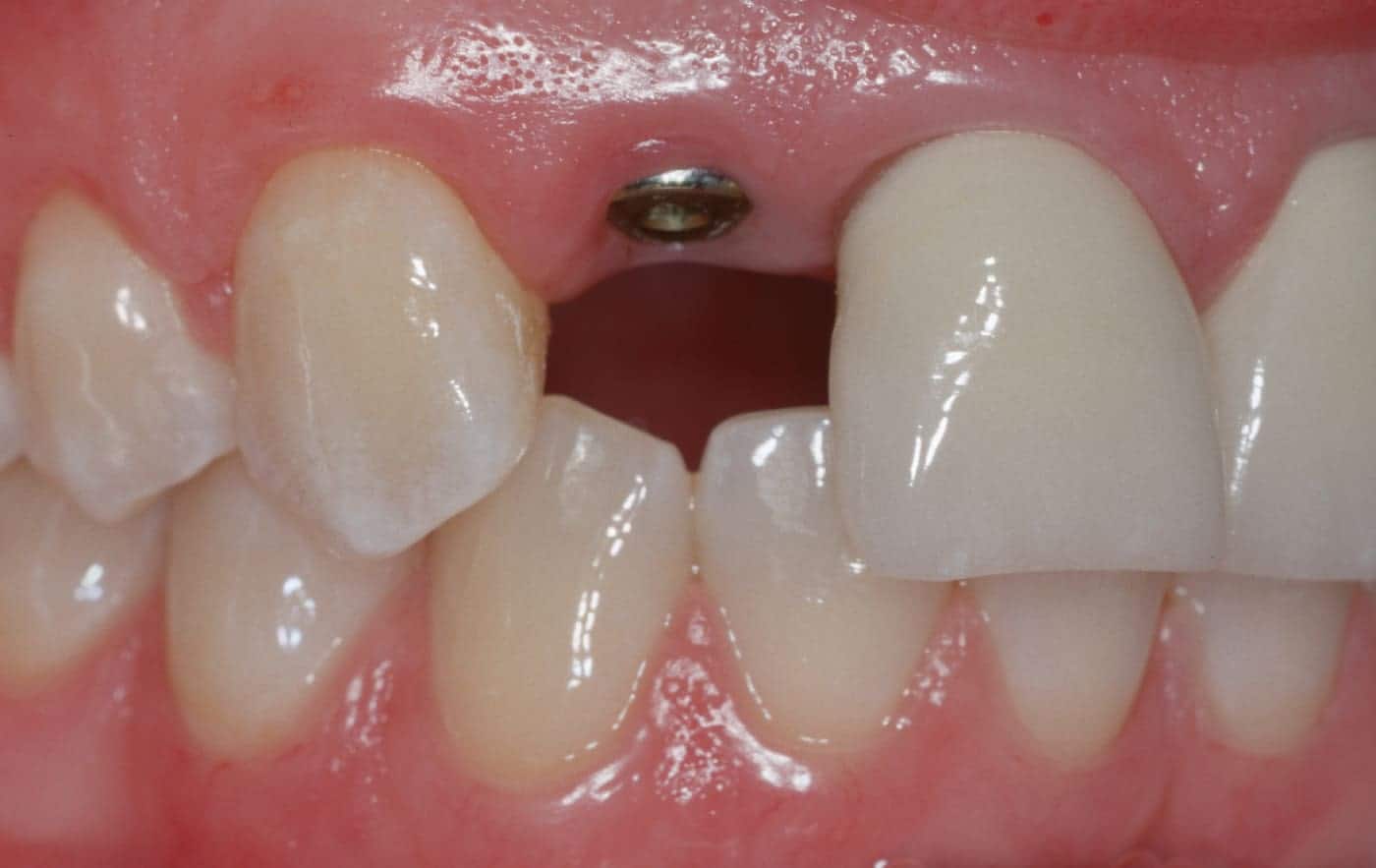 removable partial dentures, dental implants single tooth