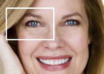 Eyelids (blepharoplasty)