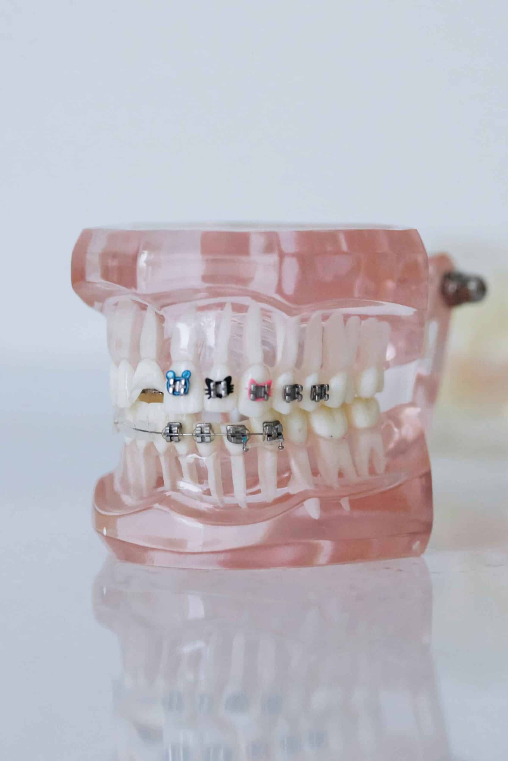 braces on teeth model