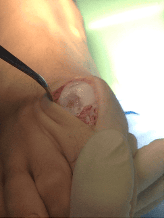 Damaged cartilage from the bone spurs