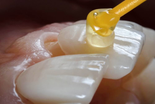 Veneers in Austin TX Dr. Brandon Hall Aspire Dental