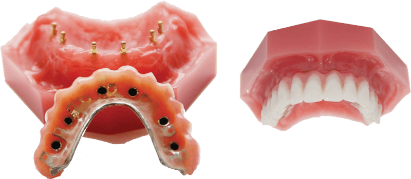 Denture Alternatives in Sterling Heights, MI | Mini Dental Implants