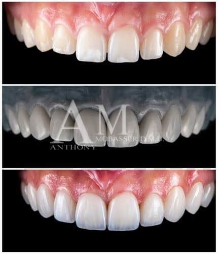 Lumineers Candidate | No Prep Veneers in Los Angeles, CA