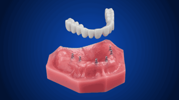 Full Dentures in East Longmeadow, MA | Book a Free Consultation