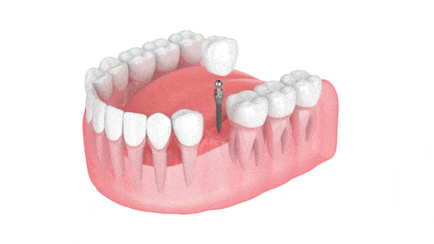 Dental Crowns in Syracuse, NY