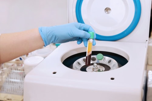 L-PRF in Melbourne, FL | Designing Smiles Dentistry | Dr. Apel