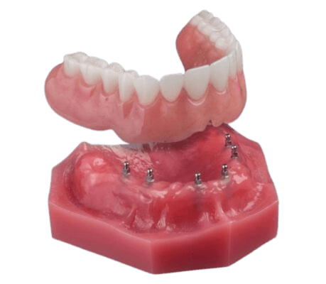 Implant Dentures Review in Union City, NJ | Overdenture