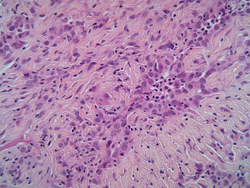 Sarcomatoid Mesothelioma Lawyers Lipsitz, Ponterio & Comerford, LLC