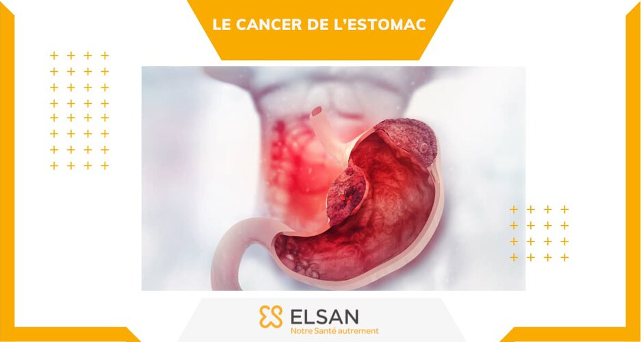 Cancer de l’estomac Symptômes et traitements — free download
