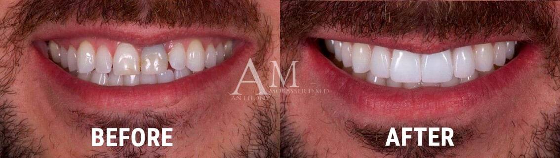 Dental-Crowns-in-Los-Angeles---Before-&-After-Dental-Crowns