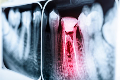 Root Canal Therapy | Union City | Diana Rodriguez & Associates