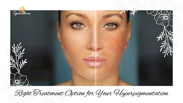 ULTIMATE GUIDE TO HYPERPIGMENTATION TREATMENT: EFFECTIVE TREATMENT OPTIONS 4 managing hyperpigmentation