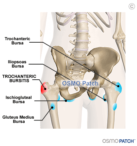 Hip Bursitis - OSMO Patch - UK