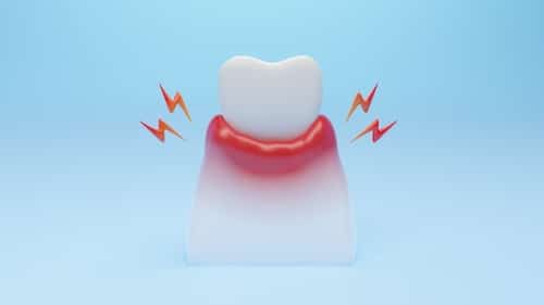 ¿Son las encías inflamadas una emergencia dental? | Carolina Dental Arts