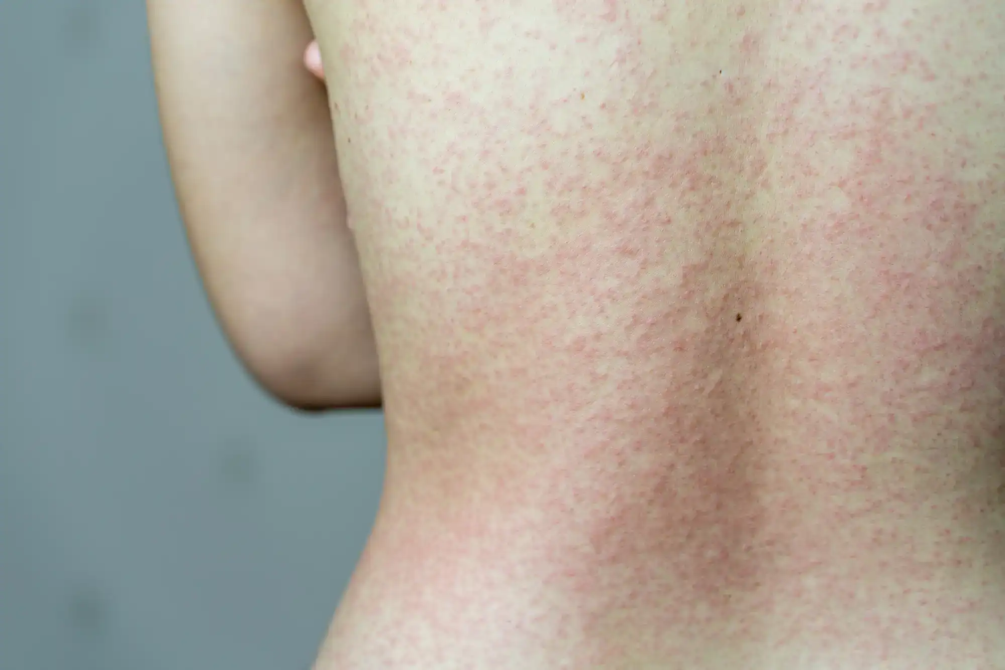 Neurodermitis Therapie Sendlinger Tor - closeup-of-skin-rash-on-the-female-back-2025-02-11-23-59-48-utc