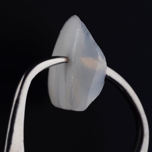 No-Prep Veneers in Los Angeles Dr. Anthony Mobasser, DMD