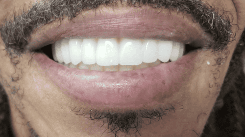 Mini Dental Implants in Scottsdale, AZ Dr. Seerat Mann