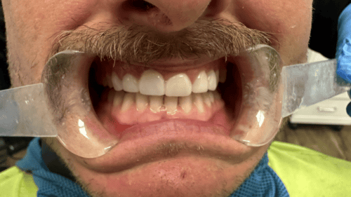 Mini Dental Implants in Scottsdale, AZ Dr. Seerat Mann