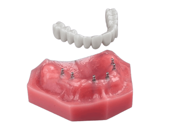 All-on-4 Alternatives in Las Vegas, NV | Fix-on-Six Mini Implants