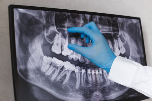 Dental 3D Scanner in Wilkes-Barre, PA Mint Mini Dental Implants