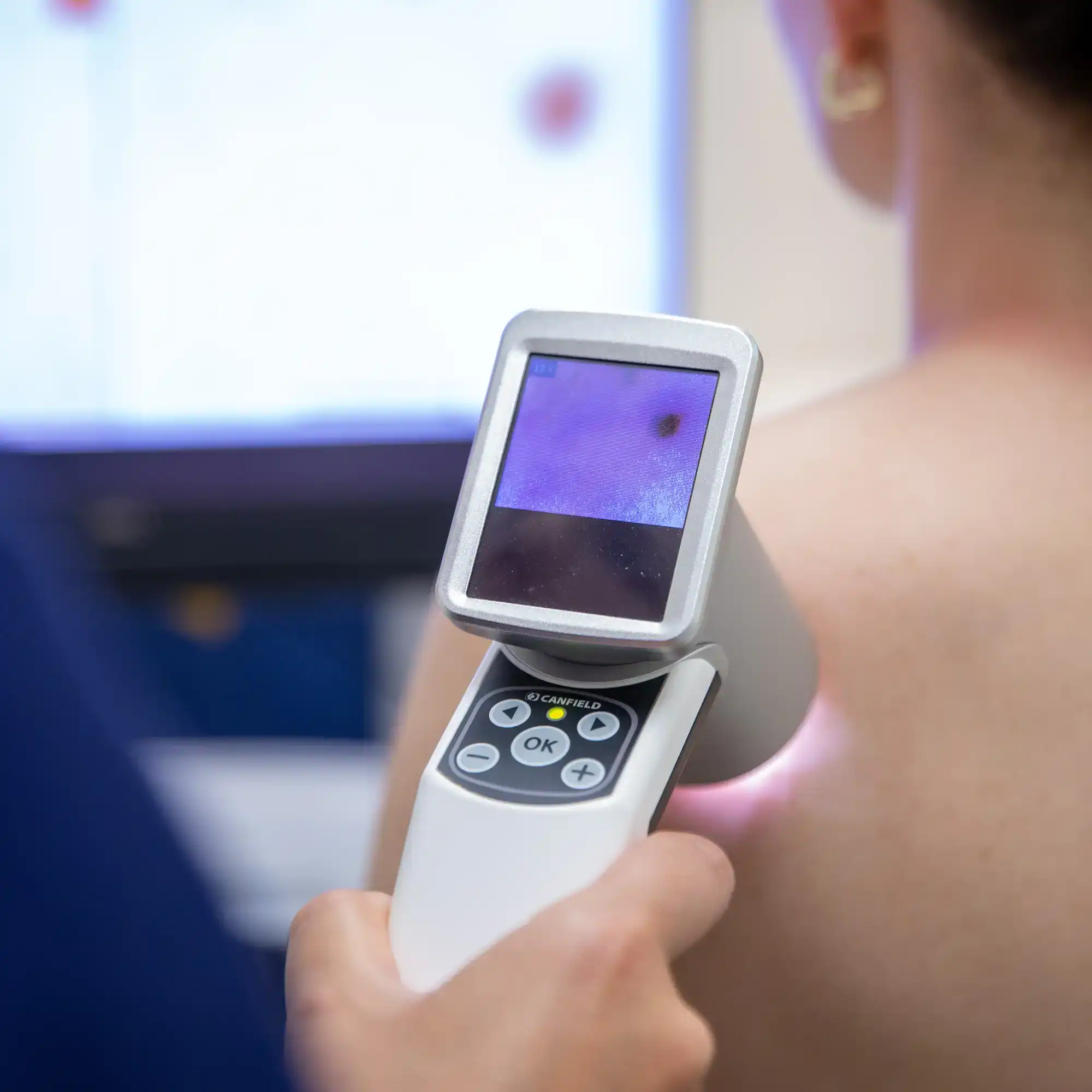 hautkrebsvorsorge dermatologie muenchensendlinger tor
