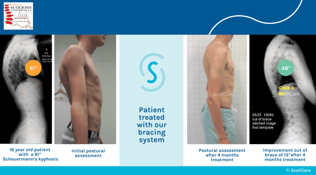 drjustintrosclair.com%2Fwp content%2Fuploads%2F2025%2F03%2FAdolescent KyphoBrace case Aus