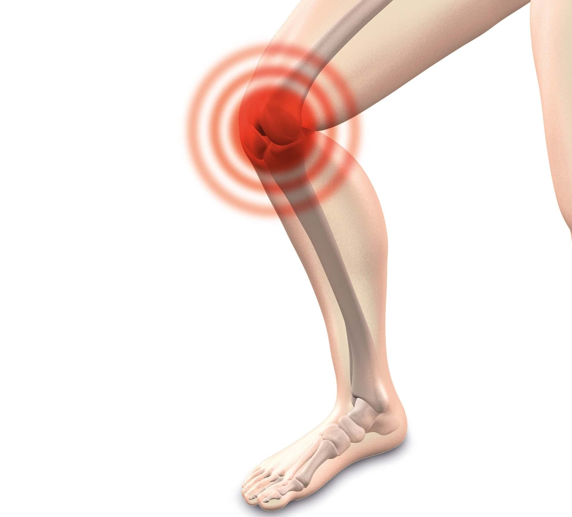 arthrocalman-2384253_1920