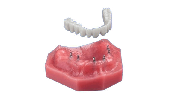 Fix-on-Six in North Carolina | A Secure Alternative to Dentures