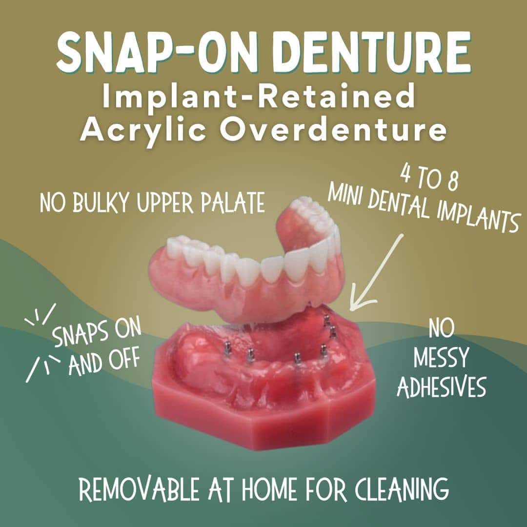 Dentaduras postizas Snap On en San Francisco East Bay