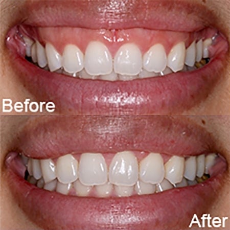 Gummy-Smile-Antes-Y-Después-Dr.-Alex-Farnoosh-La-Sonrisa-Total