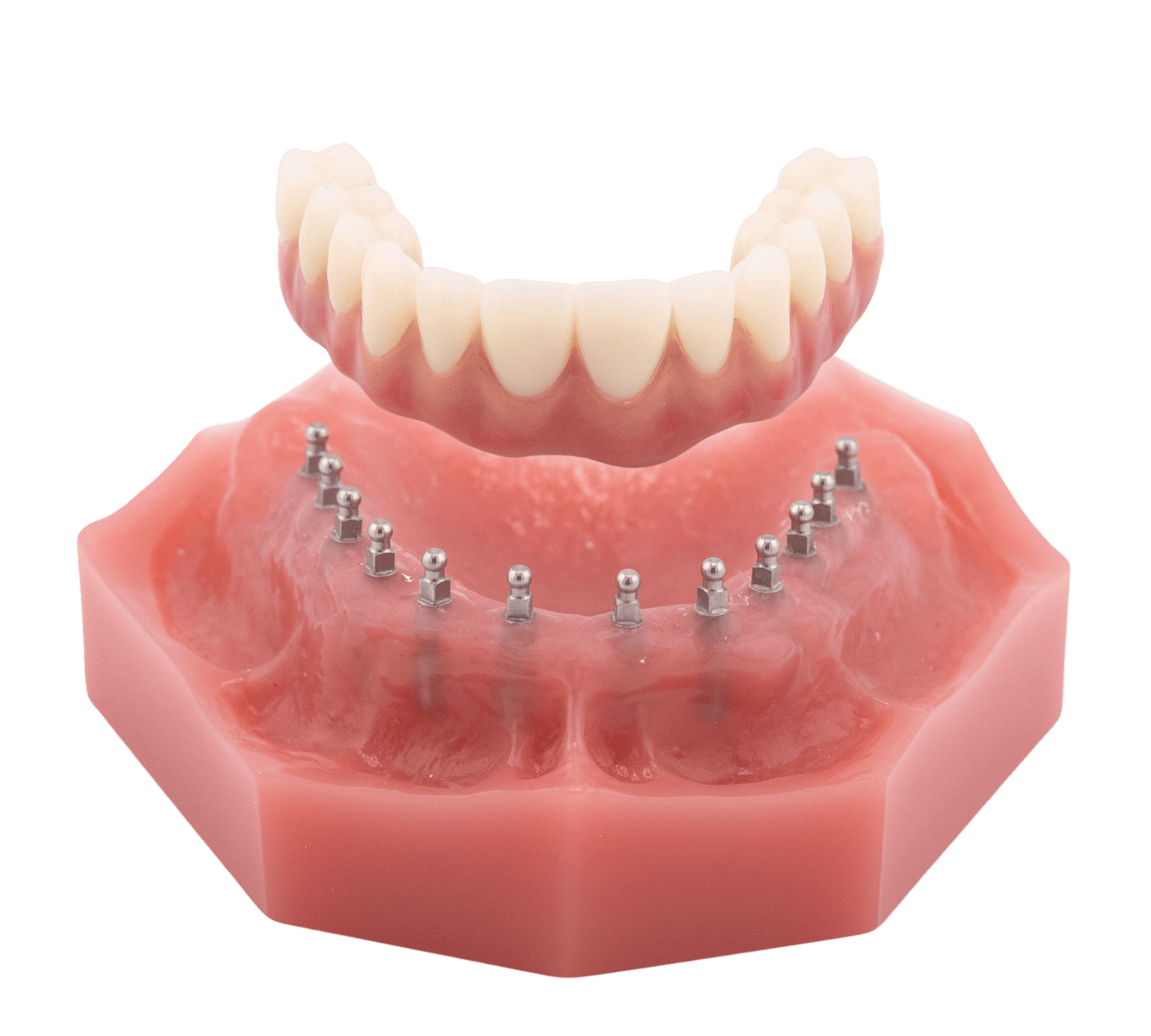 Dentures in Springfield, MO | Non-Removable Roundhouse Bridge