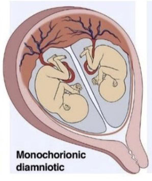 Chorionicity - International Council of Multiple Birth Organisations