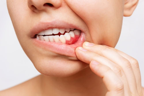 Bleeding Gums in Union City, NJ | Gum Disease Signs & Treatment