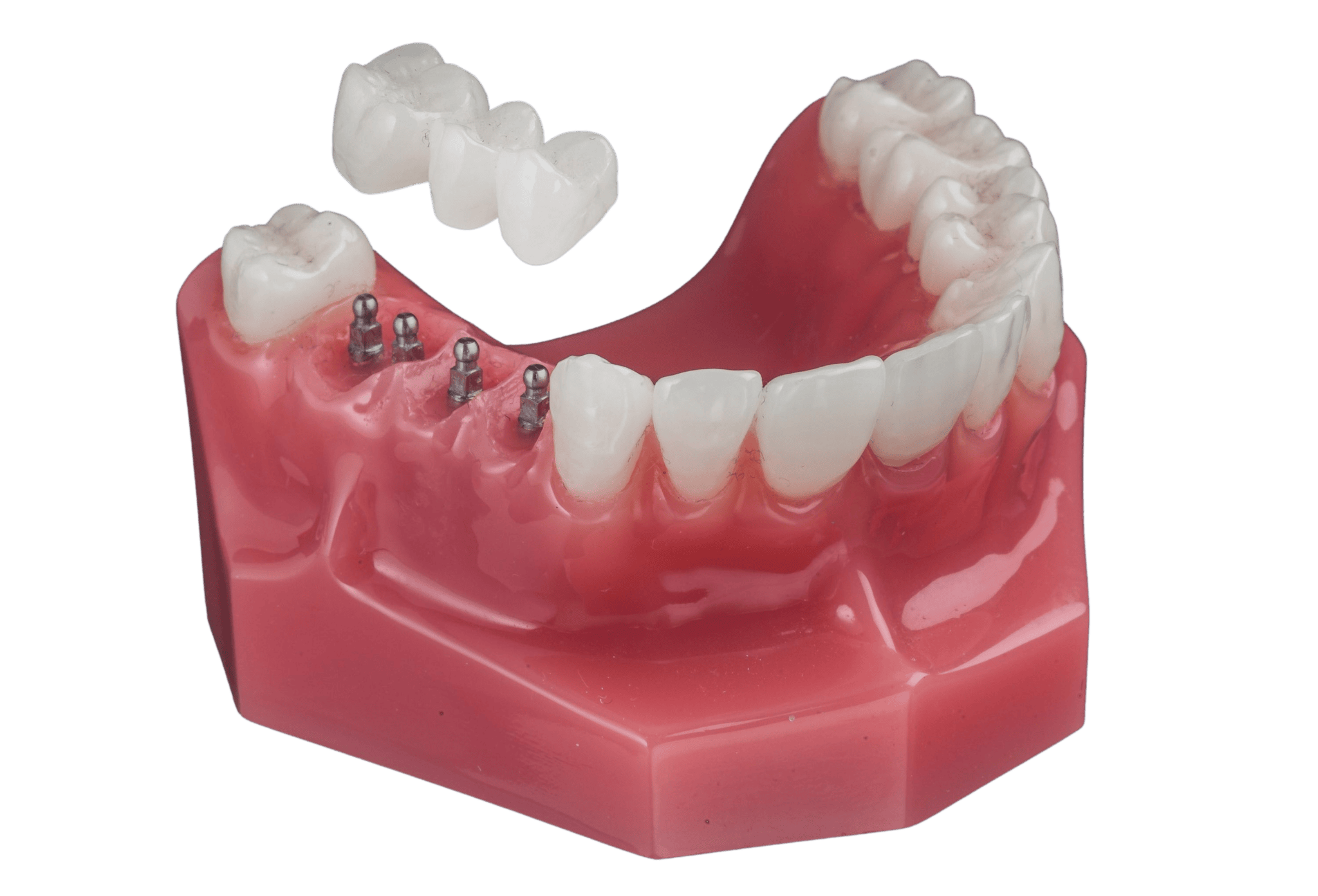Best Implant Dentist in Wayne, NJ | Schedule a Free Consultation