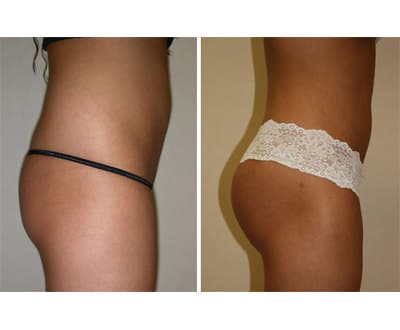 buttocks-lift3_mini