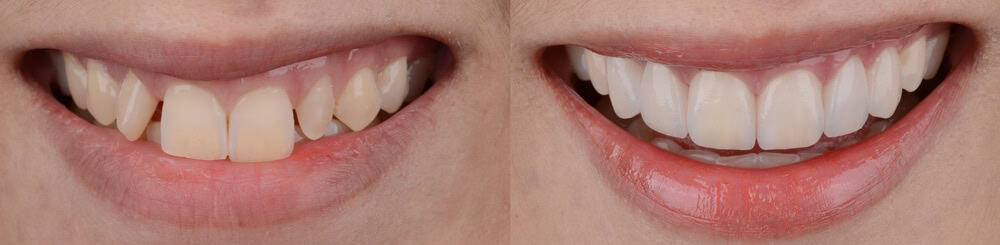 Benefits of Invisalign over Traditional Braces