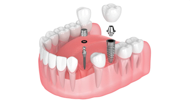 ClearChoice Alternatives in Las Vegas, NV | Mini Dental Implants
