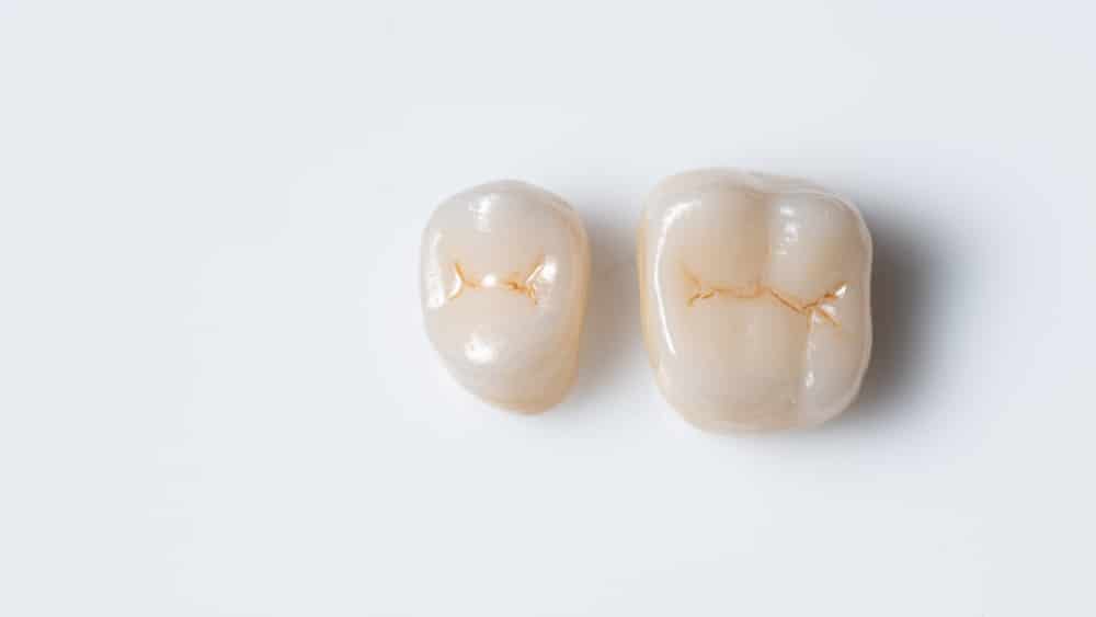 Dental Crown Treatment in Union City, NJ Dr. Diana Rodriguez
