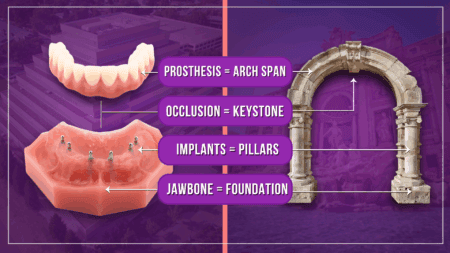 Full Arch Dental Implants in Rocklin, CA | Affordable Implant Dentures Near Me